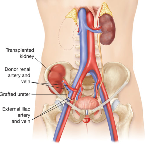 Kidney Transplant